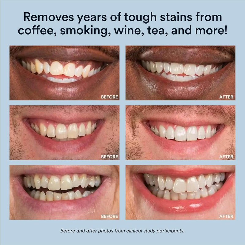 Teeth Whitening Kit