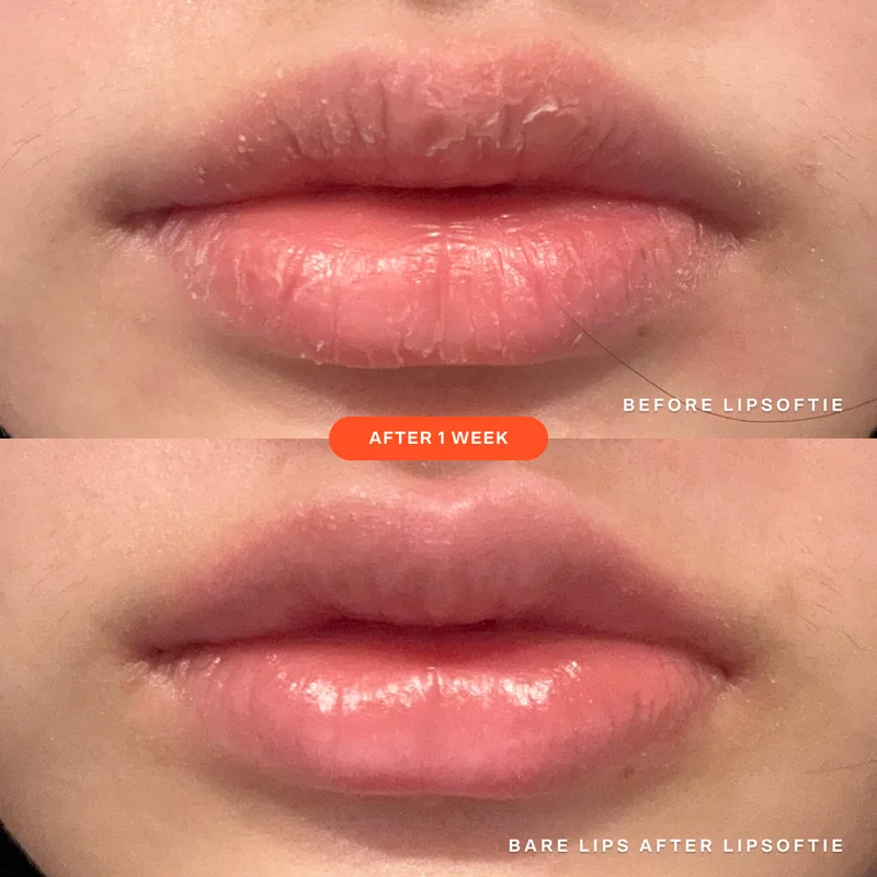 SOS LipSoftie™ Lip Treatment